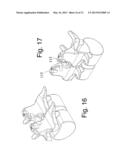 DEVICES AND METHODS FOR THE MINIMALLY INVASIVE TREATMENT OF SPINAL     STENOSIS diagram and image