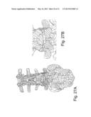 DEVICES AND METHODS FOR THE MINIMALLY INVASIVE TREATMENT OF SPINAL     STENOSIS diagram and image