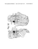 DEVICES AND METHODS FOR THE MINIMALLY INVASIVE TREATMENT OF SPINAL     STENOSIS diagram and image