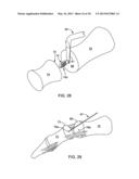 ARTHRODESIS IMPLANT AND BUTTRESSING APPARATUS AND METHOD diagram and image