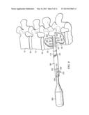 SPONDYLOLISTHESIS CORRECTION APPARATUS AND METHOD diagram and image