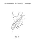 EXTERNAL STEERABLE FIBER FOR USE IN ENDOLUMINAL DEPLOYMENT OF EXPANDABLE     DEVICES diagram and image