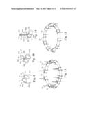 Catheter-Based Annuloplasty System and Method diagram and image