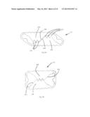 PLASTICALLY DEFORMABLE INTER-OSSEOUS DEVICE diagram and image