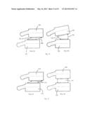 PLASTICALLY DEFORMABLE INTER-OSSEOUS DEVICE diagram and image