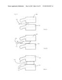 PLASTICALLY DEFORMABLE INTER-OSSEOUS DEVICE diagram and image