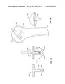 ARTHROSCOPIC TOTAL SHOULDER ARTHROPLASTY diagram and image