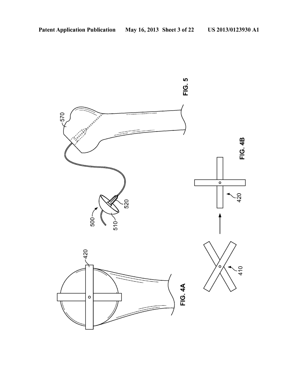 ARTHROSCOPIC TOTAL SHOULDER ARTHROPLASTY - diagram, schematic, and image 04