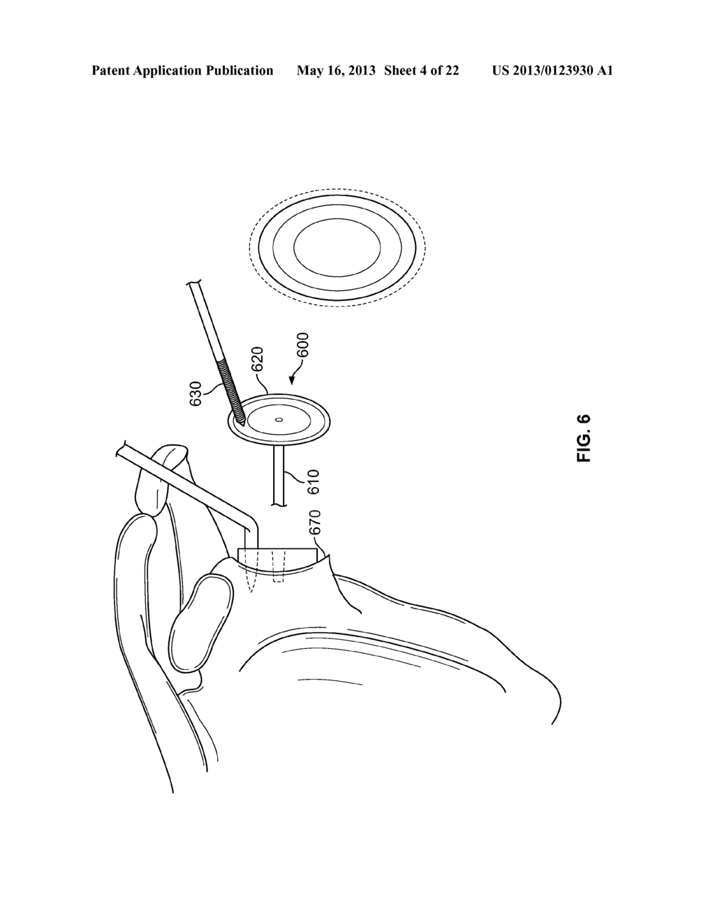 ARTHROSCOPIC TOTAL SHOULDER ARTHROPLASTY - diagram, schematic, and image 05