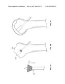 ARTHROSCOPIC TOTAL SHOULDER ARTHROPLASTY diagram and image