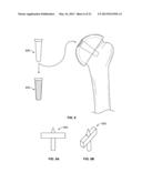 ARTHROSCOPIC TOTAL SHOULDER ARTHROPLASTY diagram and image