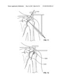 ARTHROSCOPIC TOTAL SHOULDER ARTHROPLASTY diagram and image