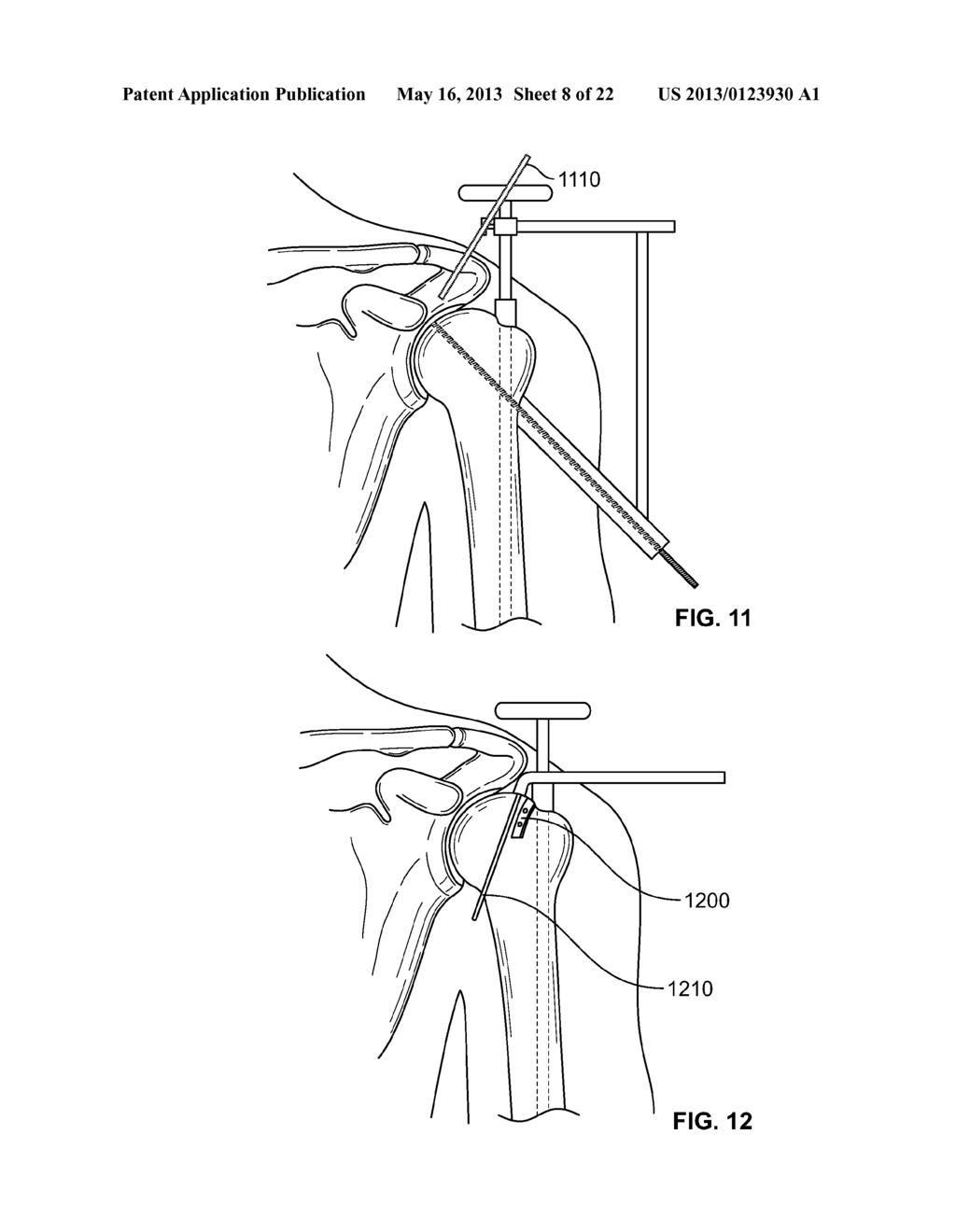 ARTHROSCOPIC TOTAL SHOULDER ARTHROPLASTY - diagram, schematic, and image 09