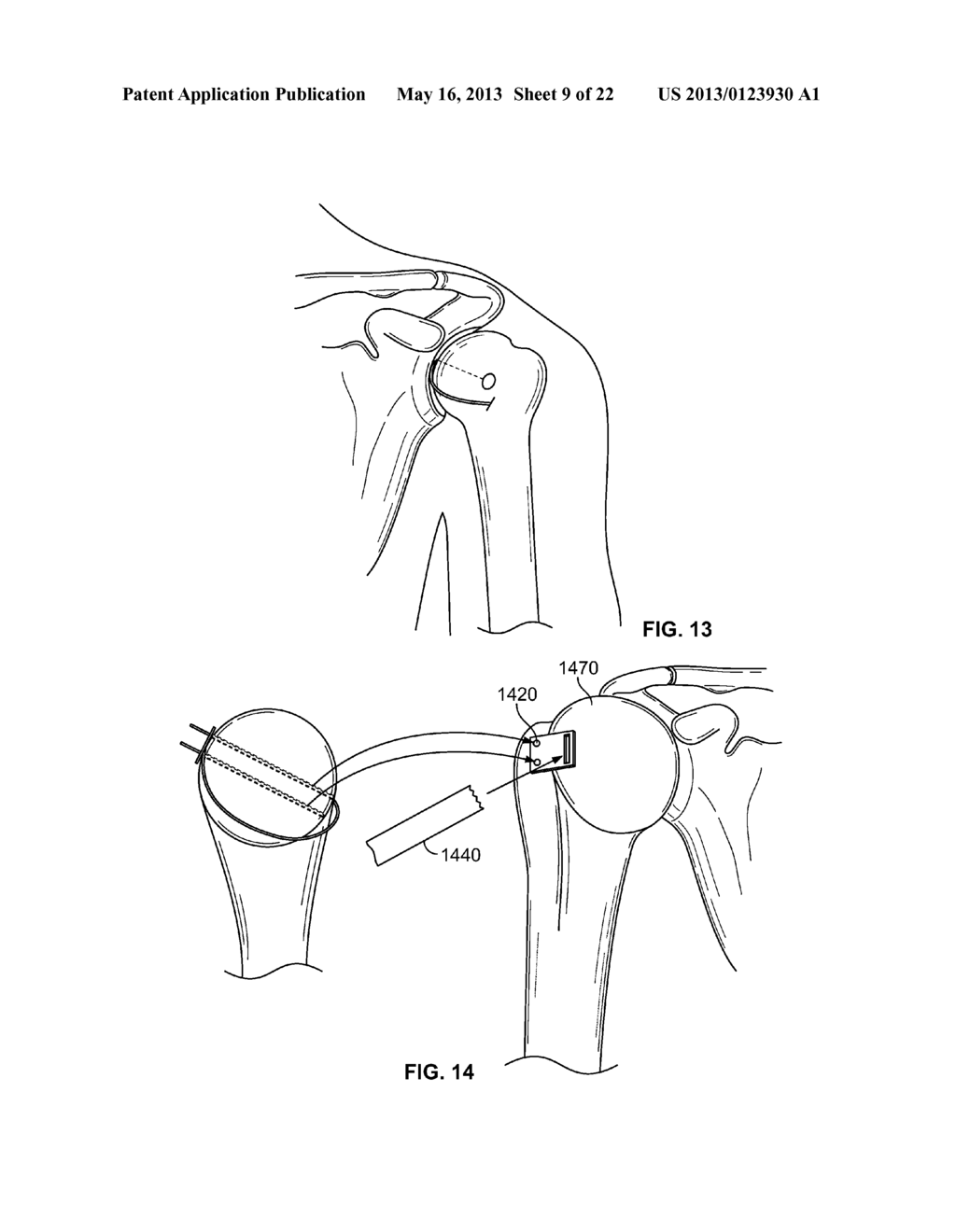 ARTHROSCOPIC TOTAL SHOULDER ARTHROPLASTY - diagram, schematic, and image 10