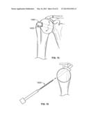 ARTHROSCOPIC TOTAL SHOULDER ARTHROPLASTY diagram and image