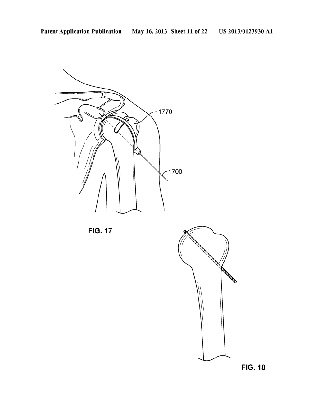 ARTHROSCOPIC TOTAL SHOULDER ARTHROPLASTY - diagram, schematic, and image 12