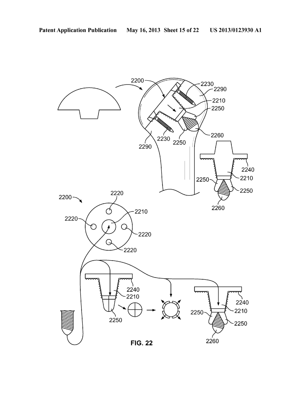 ARTHROSCOPIC TOTAL SHOULDER ARTHROPLASTY - diagram, schematic, and image 16