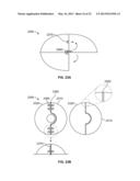 ARTHROSCOPIC TOTAL SHOULDER ARTHROPLASTY diagram and image