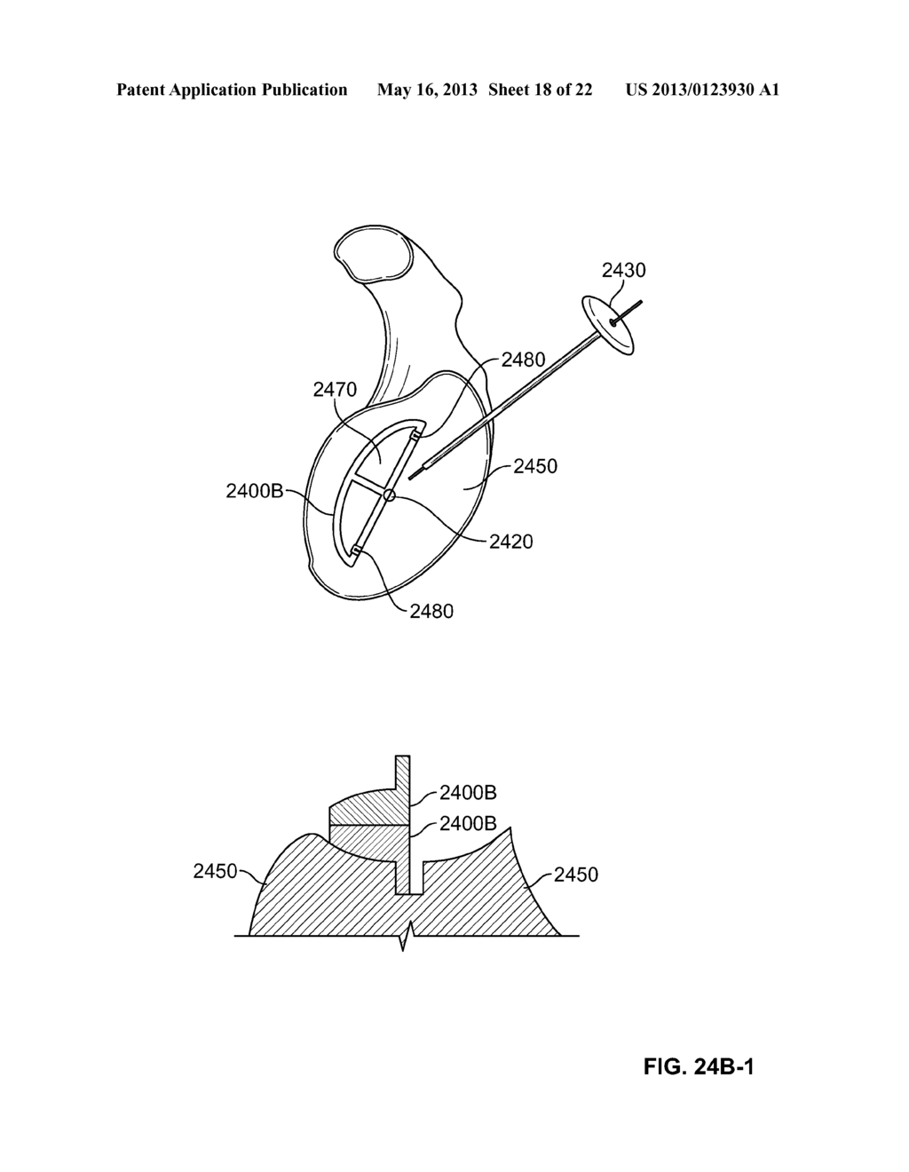 ARTHROSCOPIC TOTAL SHOULDER ARTHROPLASTY - diagram, schematic, and image 19