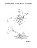 ARTHROSCOPIC TOTAL SHOULDER ARTHROPLASTY diagram and image