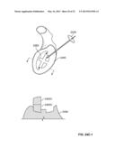 ARTHROSCOPIC TOTAL SHOULDER ARTHROPLASTY diagram and image