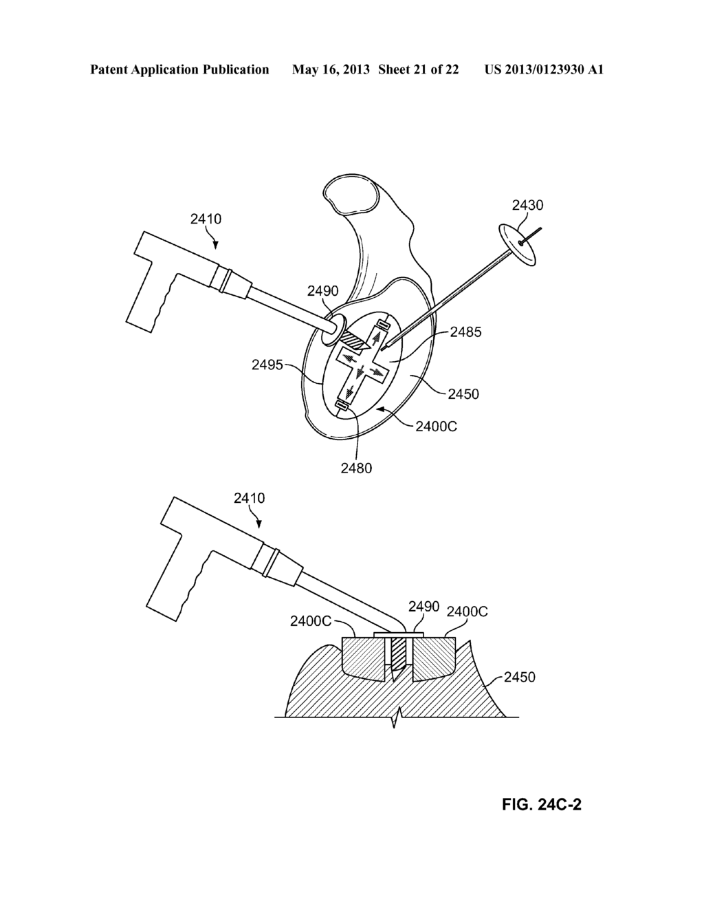 ARTHROSCOPIC TOTAL SHOULDER ARTHROPLASTY - diagram, schematic, and image 22