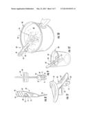 ORAL ORTHOSIS HANDLE diagram and image