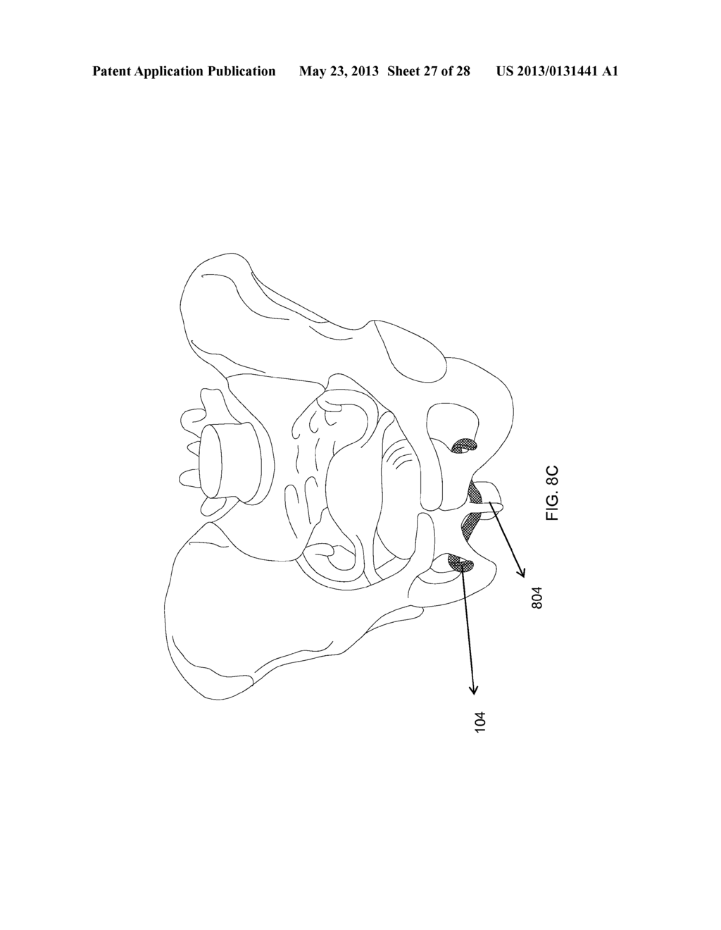 MEDICAL ASSEMBLY FOR DELIVERING AN IMPLANT - diagram, schematic, and image 28