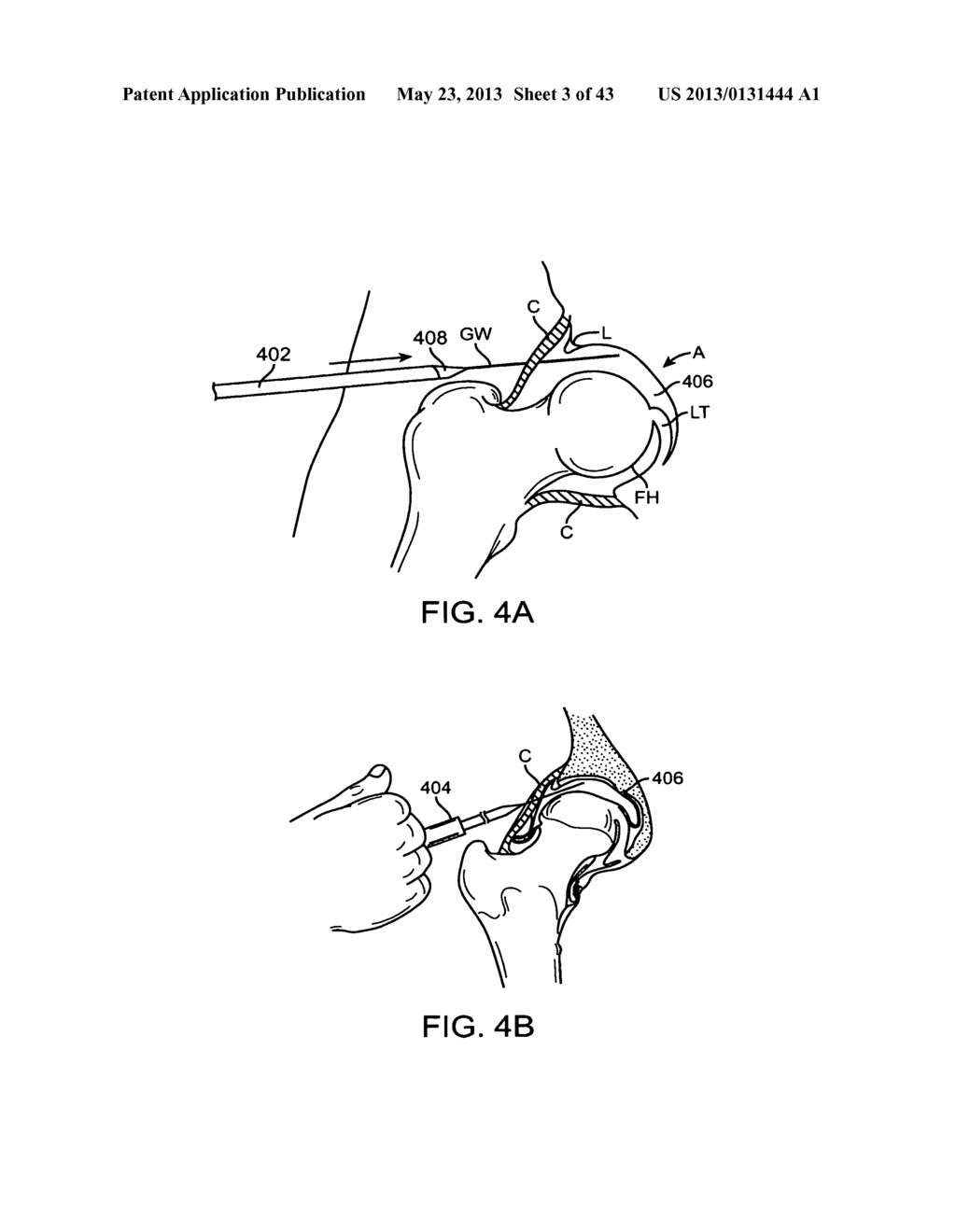 METHODS AND APPARATUS FOR JOINT DISTRACTION - diagram, schematic, and image 04