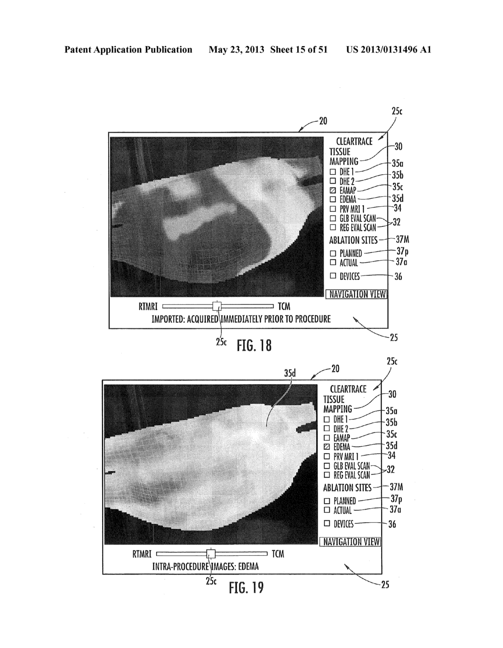 MRI-GUIDED CATHETERS - diagram, schematic, and image 16