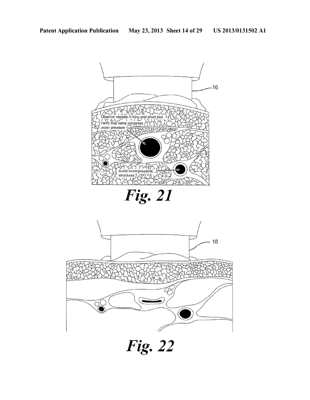 BLOOD VESSEL ACCESS SYSTEM AND DEVICE - diagram, schematic, and image 15