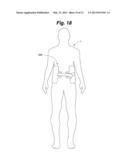 BACK BRACE SYSTEM diagram and image