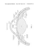 UVEOSCLERAL DRAINAGE DEVICE diagram and image