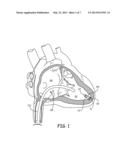 DELIVERY SYSTEM ASSEMBLIES AND ASSOCIATED METHODS FOR IMPLANTABLE MEDICAL     DEVICES diagram and image