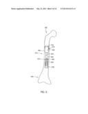 EXTERNAL ADJUSTMENT DEVICE FOR DISTRACTION DEVICE diagram and image