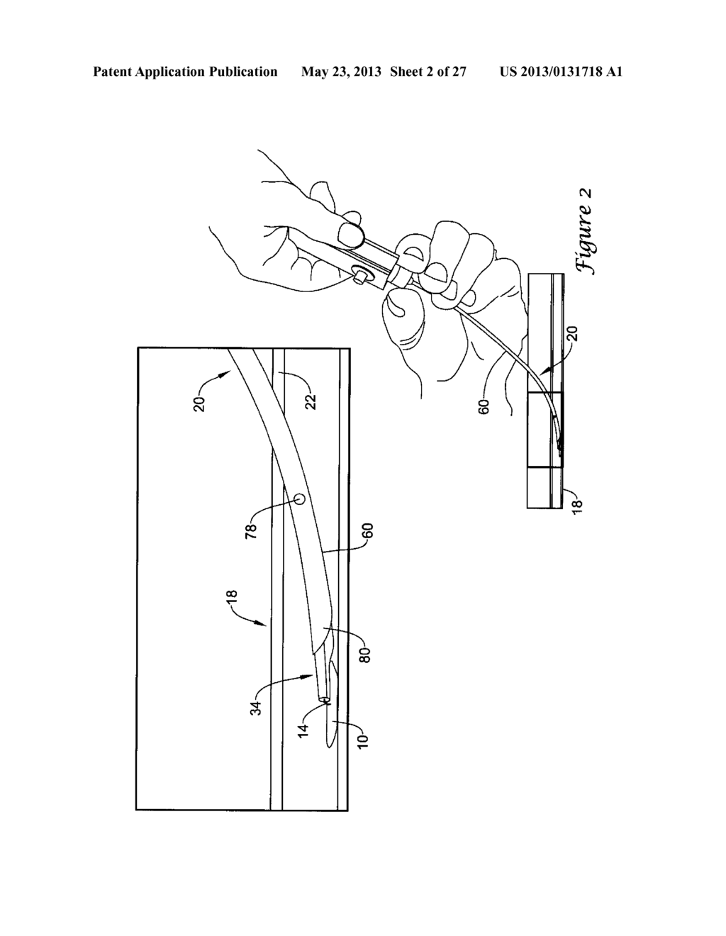 EXPANDABLE DEVICE SHEATH FOR VASCULAR CLOSURE PLUG DEPLOYMENT - diagram, schematic, and image 03