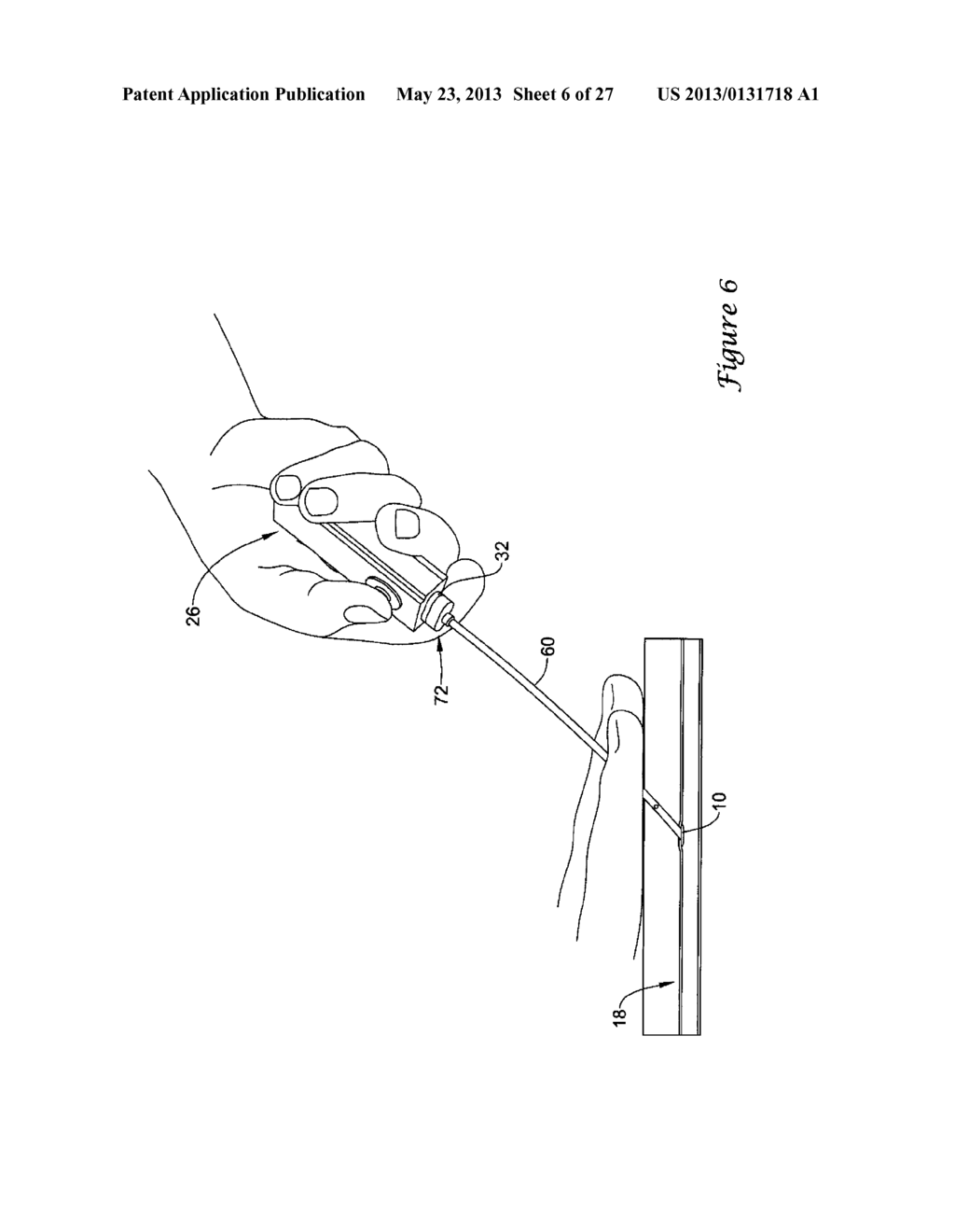 EXPANDABLE DEVICE SHEATH FOR VASCULAR CLOSURE PLUG DEPLOYMENT - diagram, schematic, and image 07