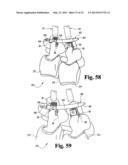 SYSTEMS AND METHODS FOR SPINAL STABILIZATION WITH FLEXIBLE ELEMENTS diagram and image