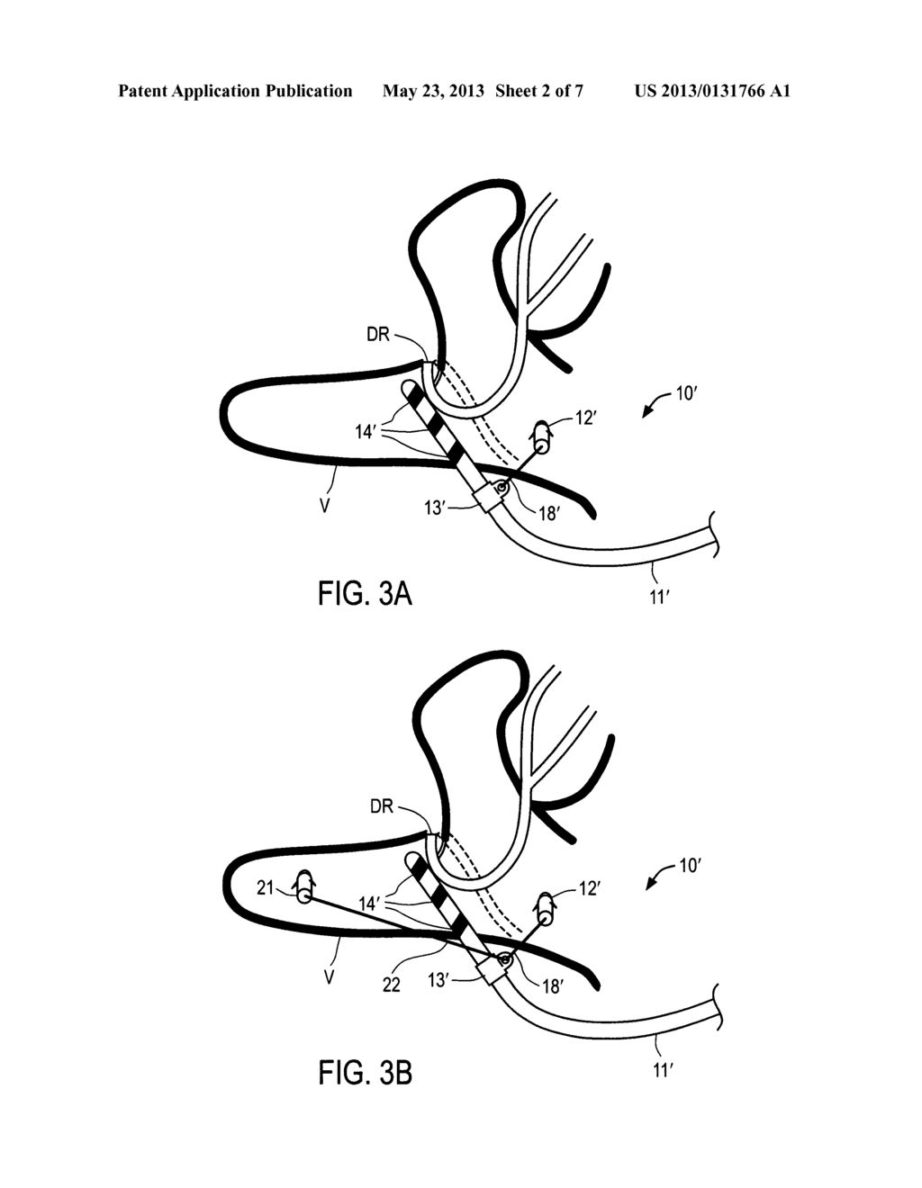 APPARATUS AND METHODS FOR ANCHORING ELECTRODE LEADS FOR USE WITH     IMPLANTABLE NEUROMUSCULAR ELECTRICAL STIMULATOR - diagram, schematic, and image 03