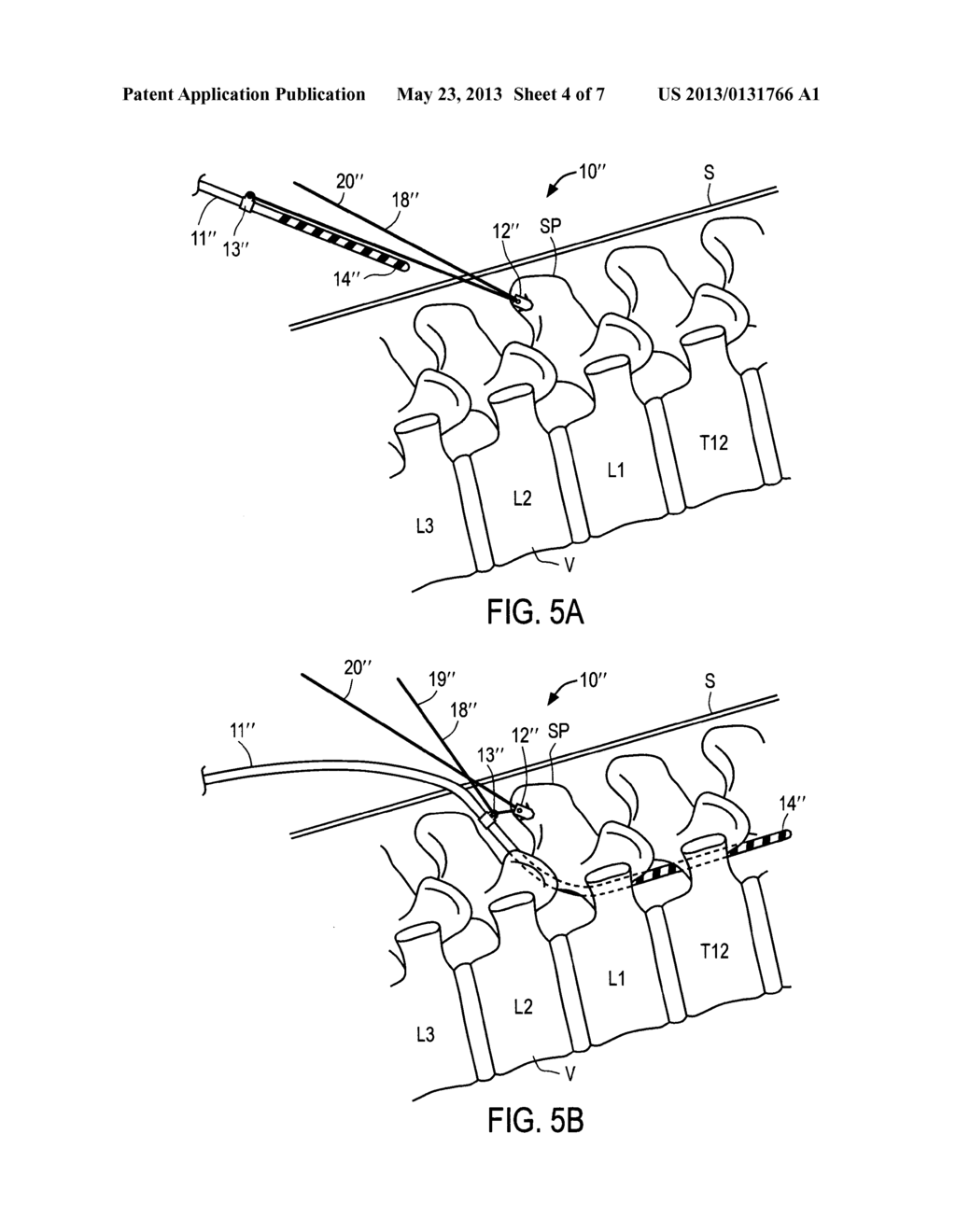 APPARATUS AND METHODS FOR ANCHORING ELECTRODE LEADS FOR USE WITH     IMPLANTABLE NEUROMUSCULAR ELECTRICAL STIMULATOR - diagram, schematic, and image 05