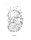 ELECTRICAL STIMULATION OF THE SYMPATHETIC NERVE CHAIN diagram and image