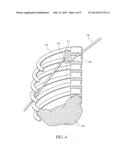 ELECTRICAL STIMULATION OF THE SYMPATHETIC NERVE CHAIN diagram and image