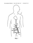 DEVICE AND METHOD FOR ESTABLISHING AN ARTIFICIAL ARTERIO-VENOUS FISTULA diagram and image