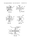 DEVICE AND METHOD FOR ESTABLISHING AN ARTIFICIAL ARTERIO-VENOUS FISTULA diagram and image