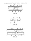 DEVICE AND METHOD FOR ESTABLISHING AN ARTIFICIAL ARTERIO-VENOUS FISTULA diagram and image