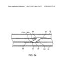 DEVICE AND METHOD FOR ESTABLISHING AN ARTIFICIAL ARTERIO-VENOUS FISTULA diagram and image