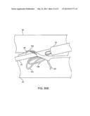 DEVICE AND METHOD FOR ESTABLISHING AN ARTIFICIAL ARTERIO-VENOUS FISTULA diagram and image