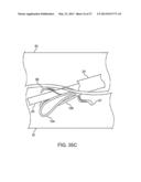 DEVICE AND METHOD FOR ESTABLISHING AN ARTIFICIAL ARTERIO-VENOUS FISTULA diagram and image