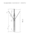 ENDOLUMINAL PROSTHESIS INTRODUCER diagram and image