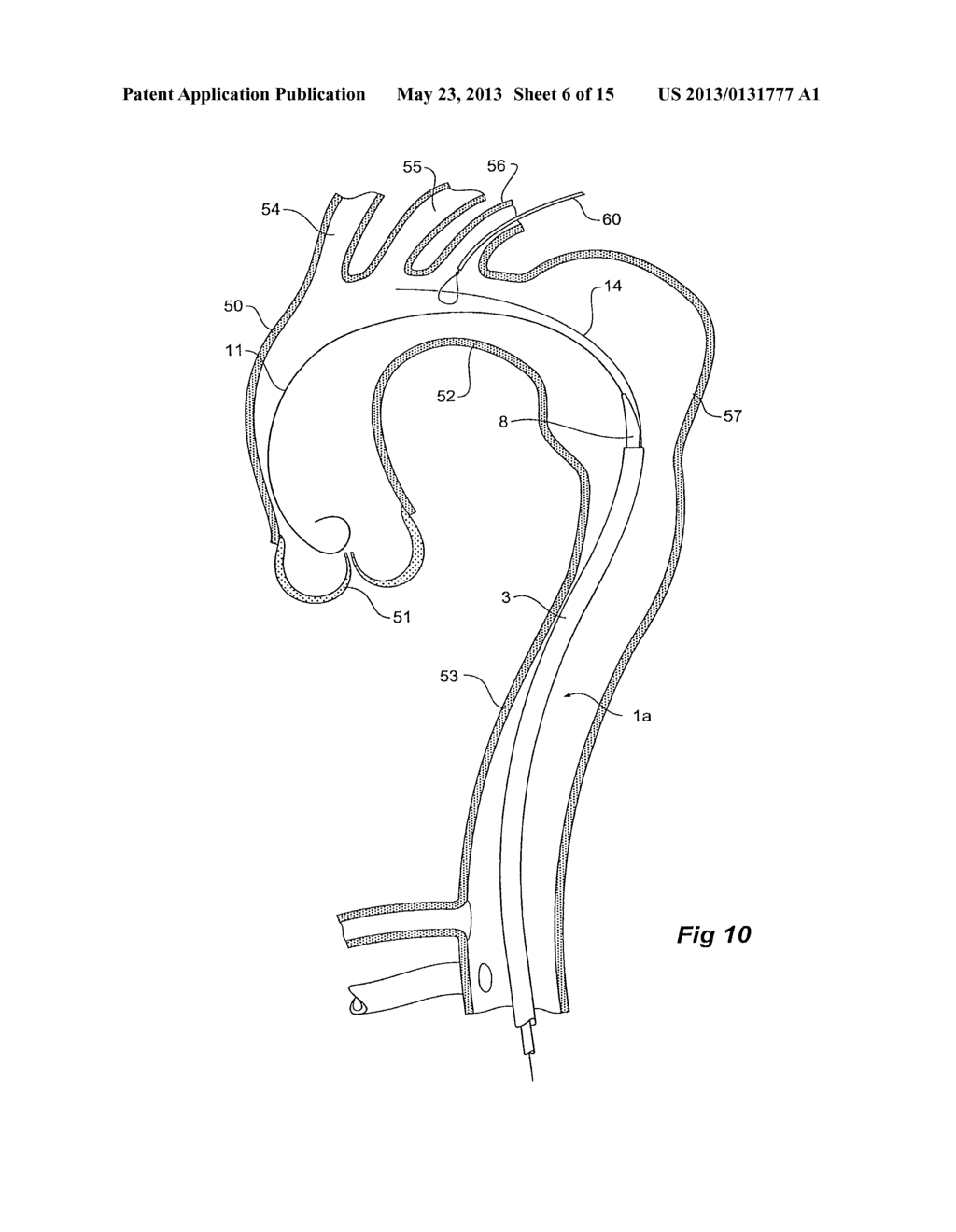 BRANCH STENT GRAFT DEPLOYMENT AND METHOD - diagram, schematic, and image 07